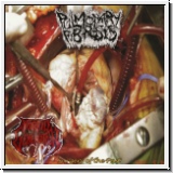 PULMONARY FIBROSIS/PILOCYSTIC ASTROCYTOMA - Split CD